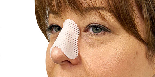 Rhinoplasty