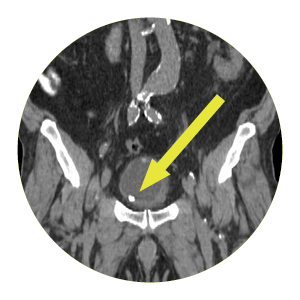 BioXmark Fiducial Marker shown on scan
