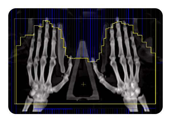 scan of hands with arthritis