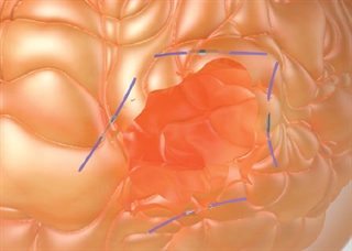 Accusyte Implantation