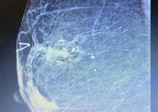Accusyte Breast