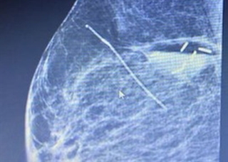 Accusyte Breast