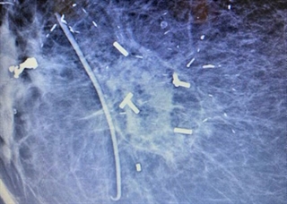 Accusyte Breast Tissue