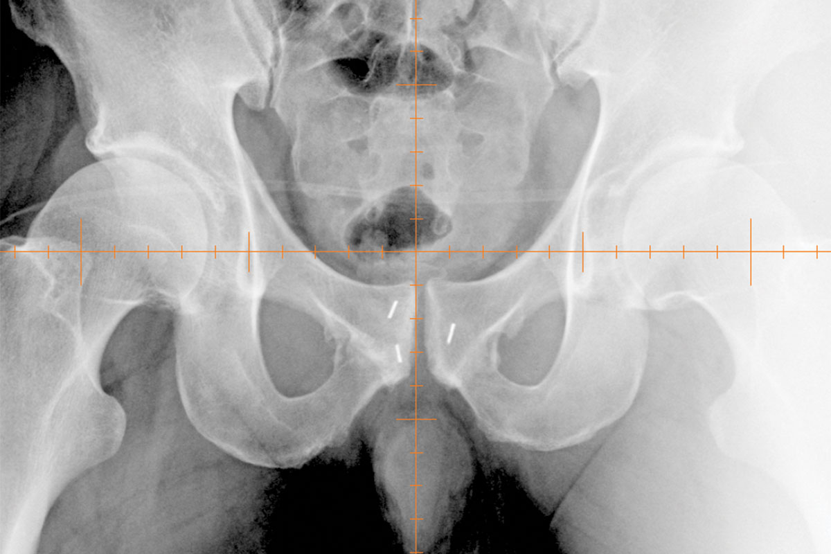 健康・医学 Occlusion Imaging diagnosis and efficacy monitoring by [89Zr]Zr-DFO