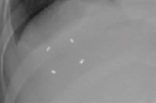 PointCoil Lung Image